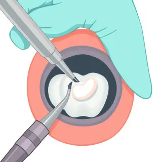 رسم توضيحي لكلمة filling